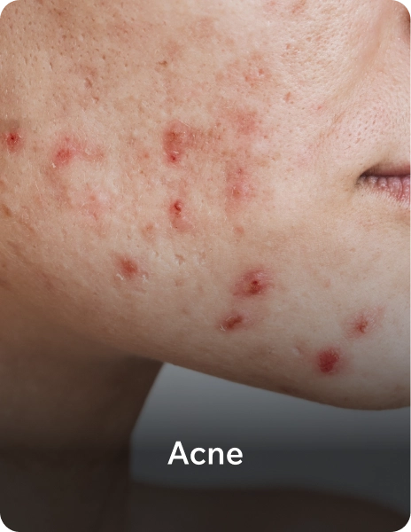 acne