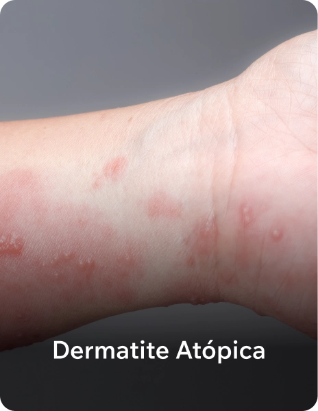 dermatite_at_pica