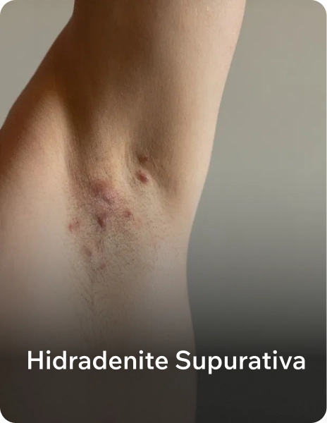 _hidradenite_supurativa