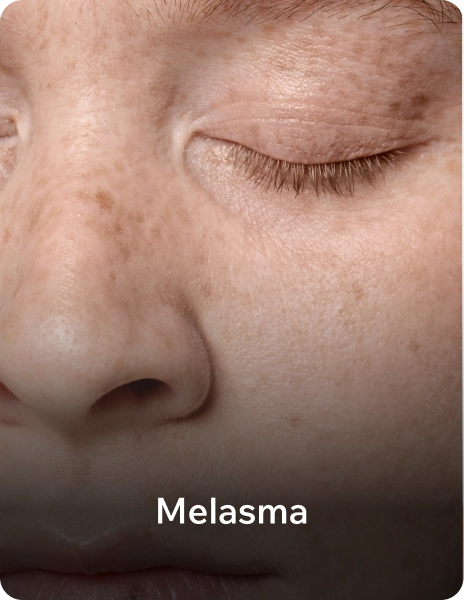 melasma