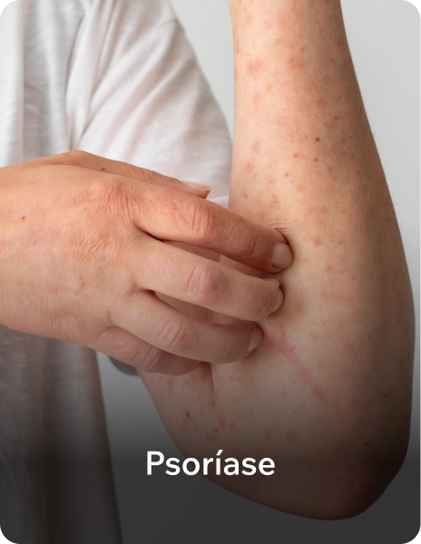 psor_ase